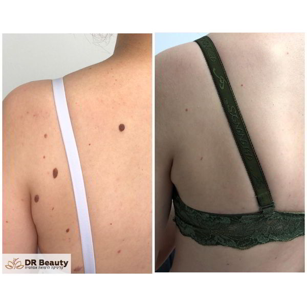 Удаление кожного образования — результат процедуры в Dr. Beauty